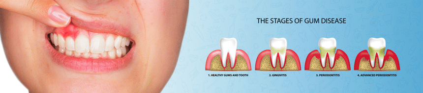 gum-disease-banner