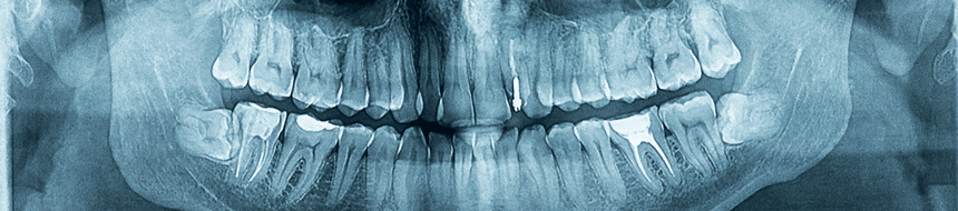 pterygoid-implants-banner