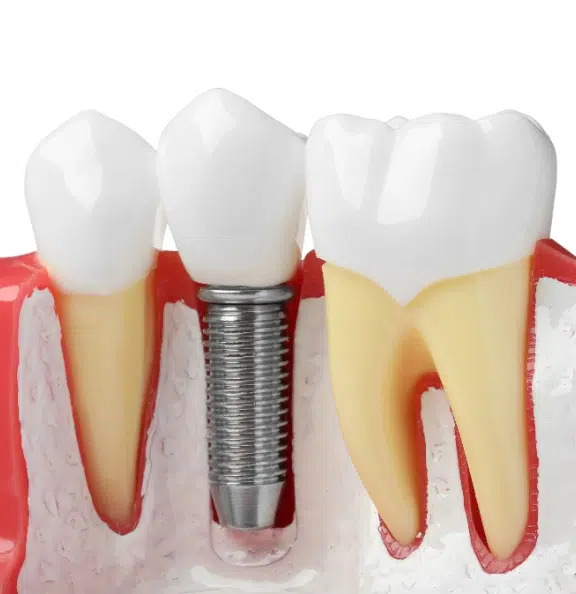 Dental-implants
