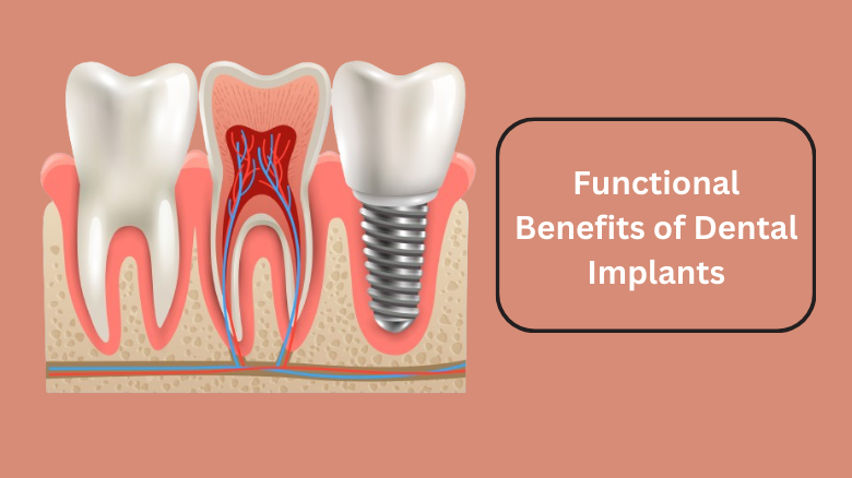 Functional Benefits of Dental Implants