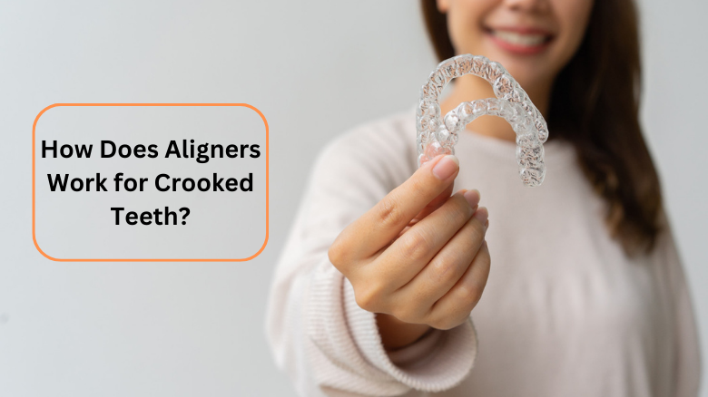 How Does Aligners Work for Crooked Teeth