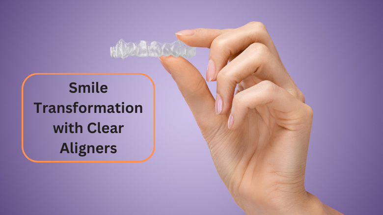Smile Transformation with Clear Aligners