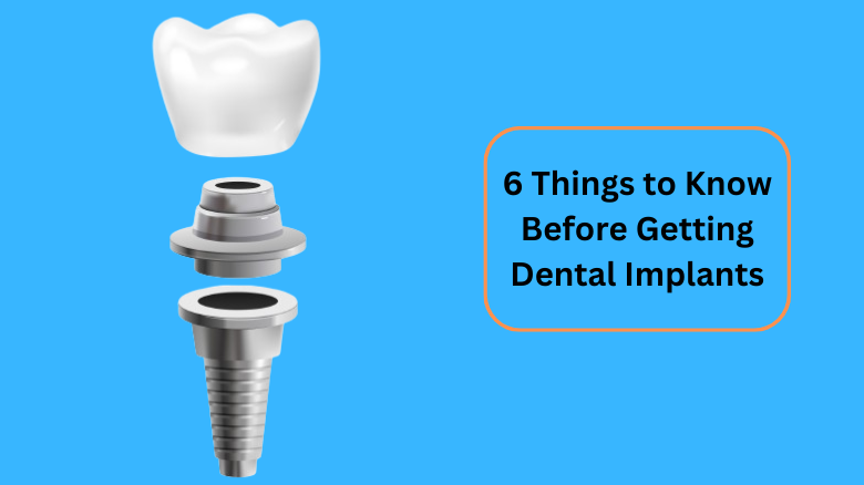 6 Things to Know Before Getting Dental Implants