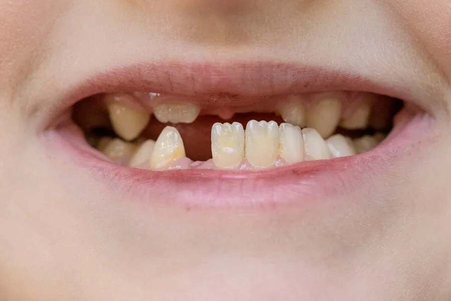 GAP BETWEEN TEETH