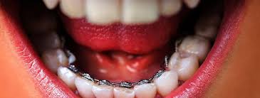 Invisalign in Hyderabad