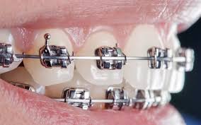 cosmetic dentistry in hyderabad