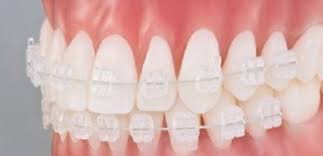 Invisalign in Hyderabad