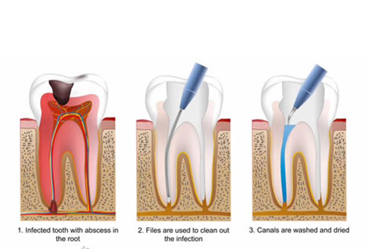 root canal treatment in hyderabad