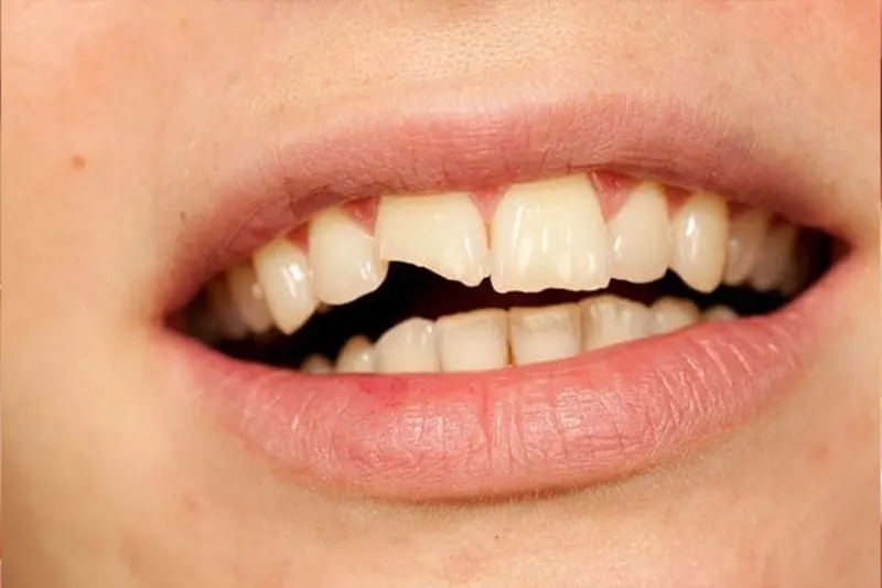 Cracked Teeth treatment