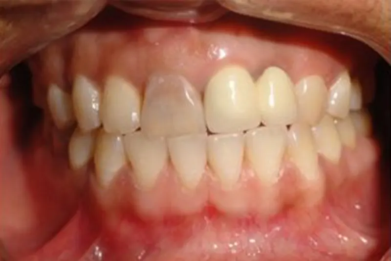 root canal treatment in hyderabad