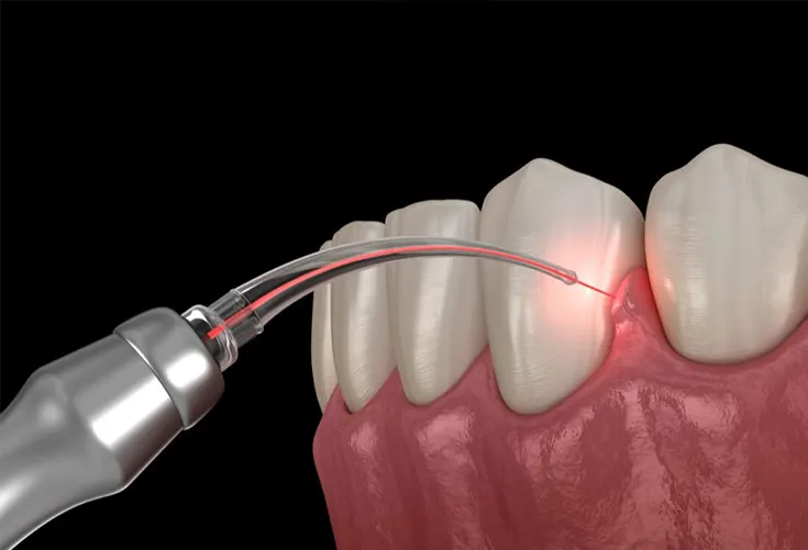 invisible braces in hyderabad