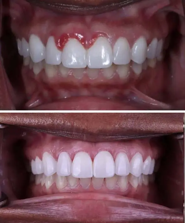 Periodontist Treatment at Hyderabad Smiles