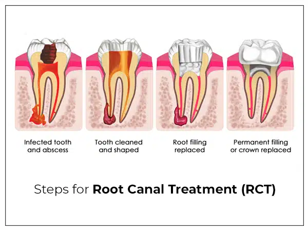 Steps for root canal treatment