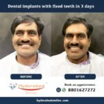 Teeth Whitening in Hyderabad