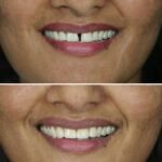 teeth whitening in hyderabad