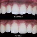 teeth whitening in hyderabad