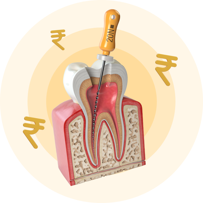 root canal treatment in hyderabad
