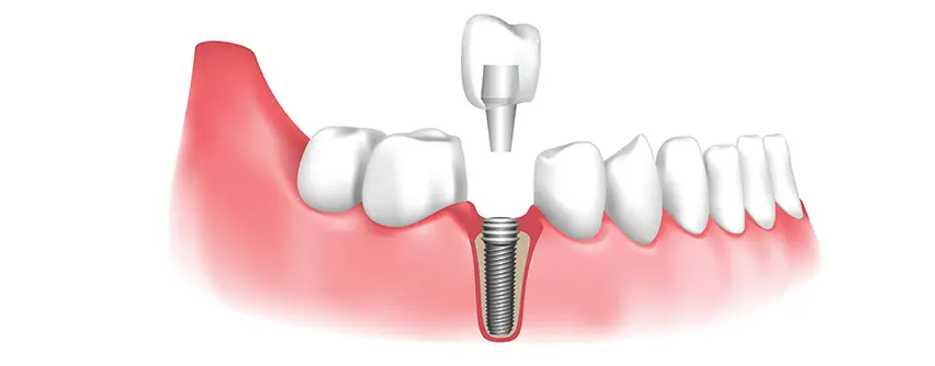 Periodontist Treatment at Hyderabad Smiles