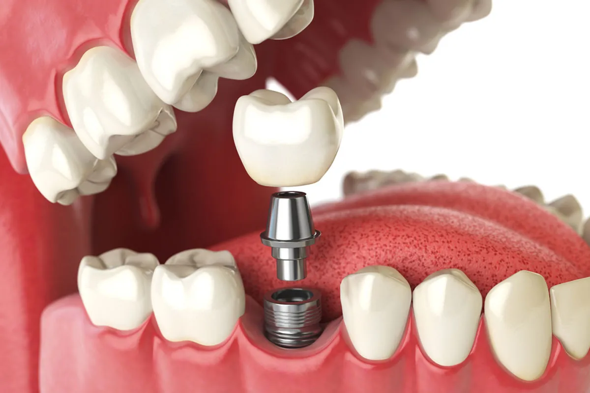 dental implants
