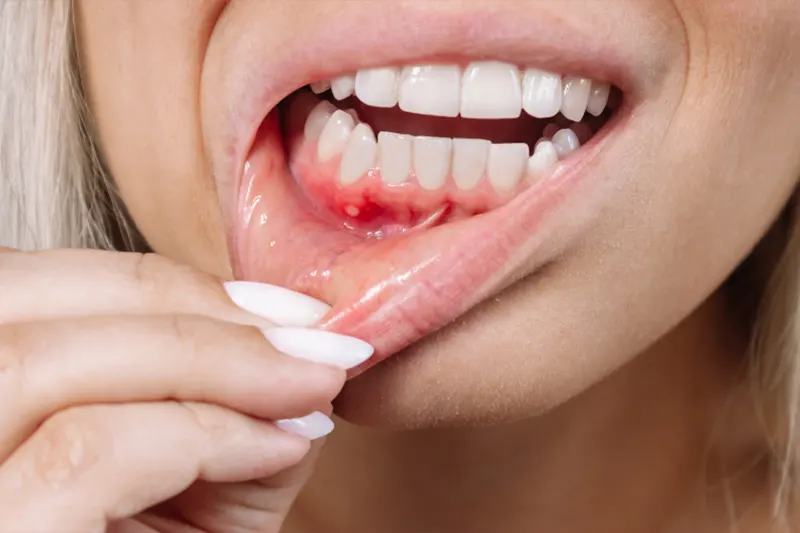 gum disease
