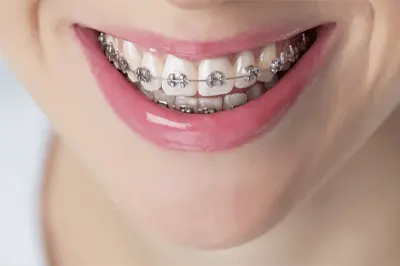 invisible braces in hyderabad