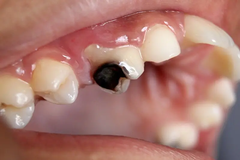 Cracked Teeth treatment