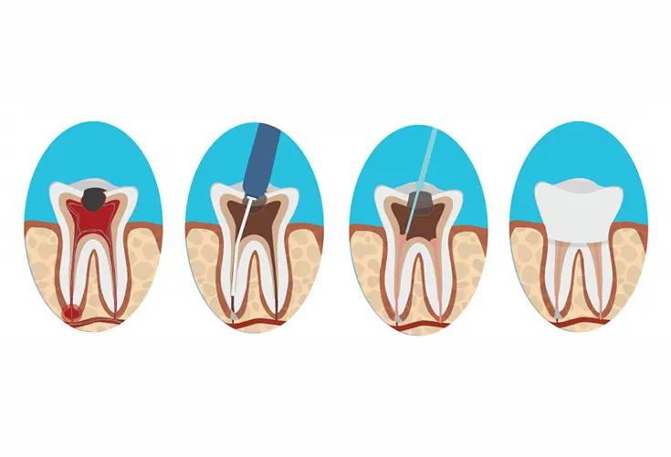 root canal treatment in hyderabad