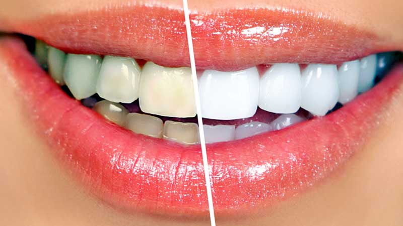 Teeth Whitening in Hyderabad