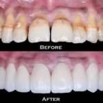 teeth whitening in hyderabad