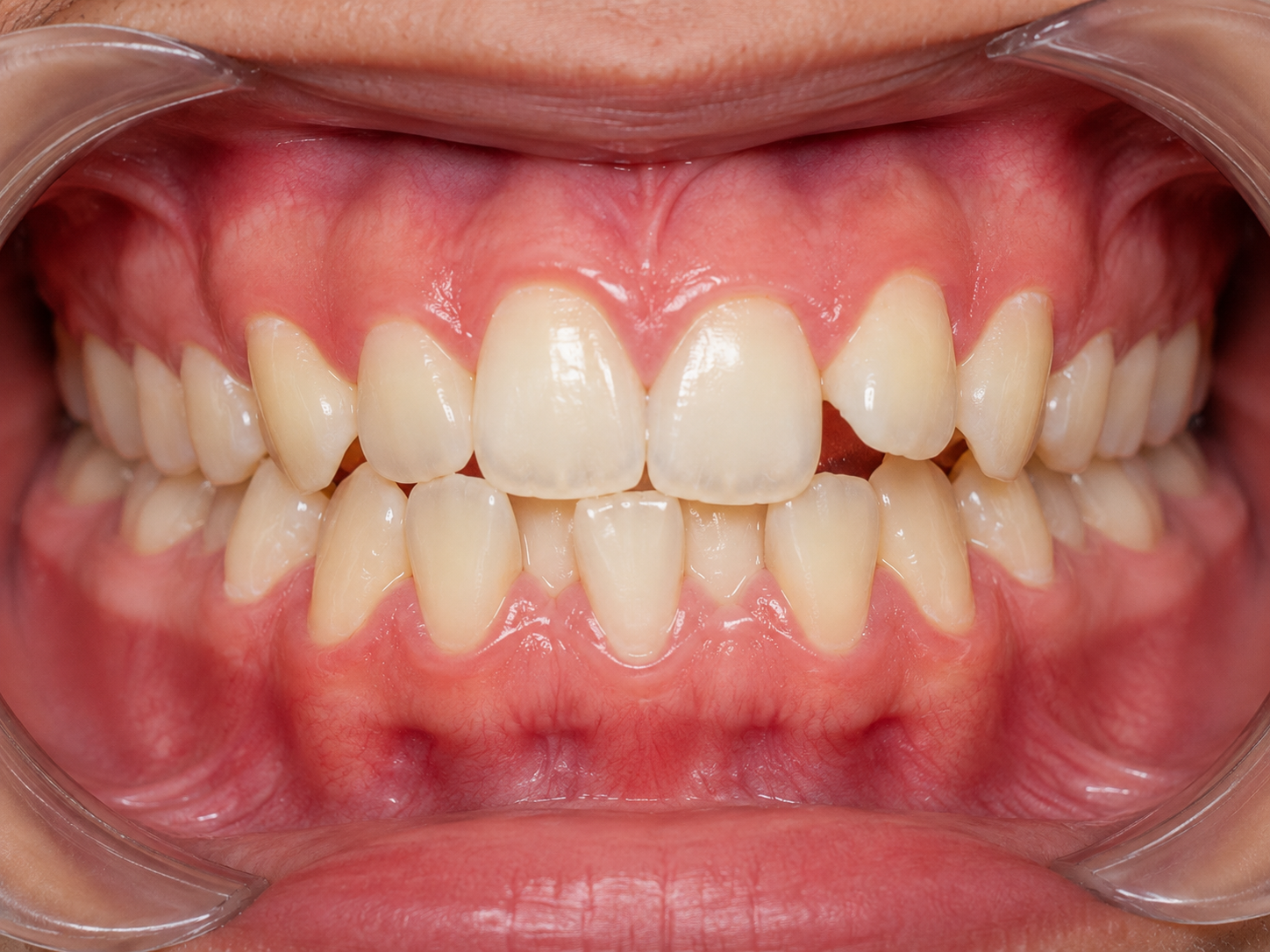 Aligners before treatment