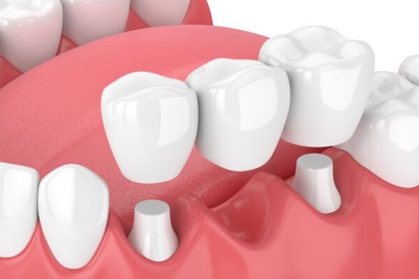 Dental Crowns