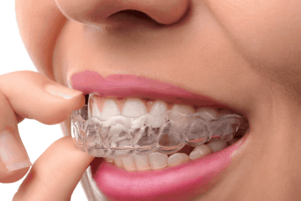 Invisible Dental Aligners