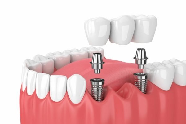 Dental Implants Image